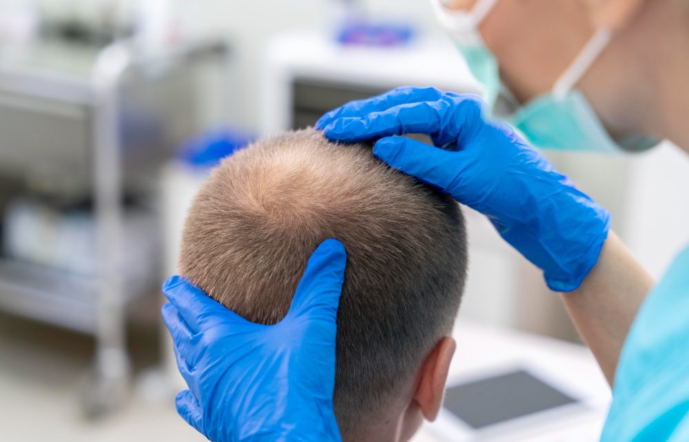 Protesi capelli di alta qualità: tutto ciò che devi sapere Protesi capelli di alta qualità: tutto ciò che devi sapere