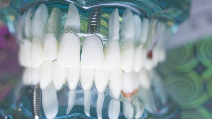 Corone dentali su denti anteriori: estetica e funzionalità